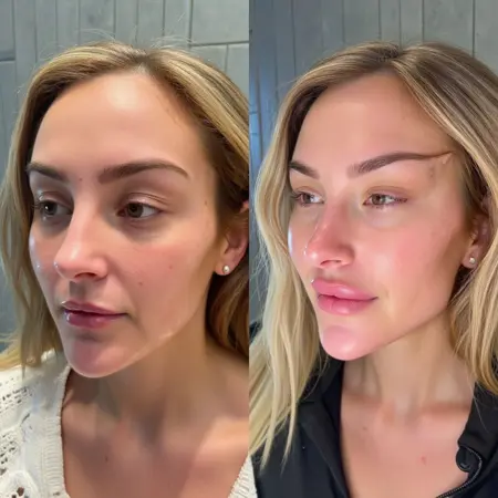 Facial Contouring | Before / After [FLUX]