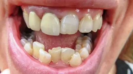 Bad Teeth