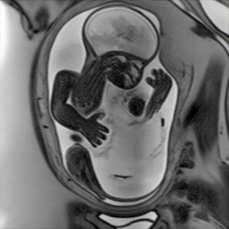 Fetal MRIs V1