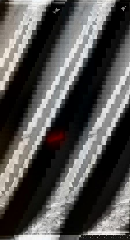 OsteoXRay_V0.1_Flux_Kontext_JGF v0.1